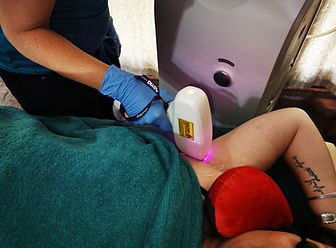 laser hair removal